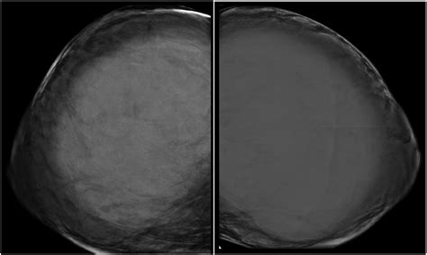 rapid breast expansion|A case of acute onset gigantomastia in a 20